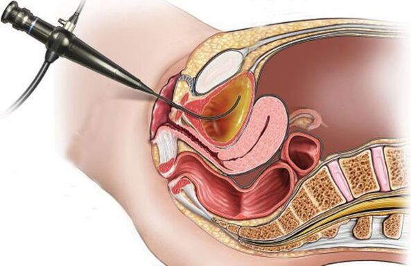 Zystoskopie bei Blasenentzündung